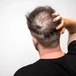 افزایش خطر ریزش مو با مصرف نوشیدنی‌های شیرین