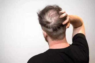 افزایش خطر ریزش مو با مصرف نوشیدنی‌های شیرین
