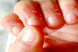 علت پوست‌پوست شدن اطراف ناخن و روش‌های درمان