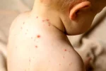 هشدار مینو محرز درباره آمار فاجعه‌بار سرخک در ایران