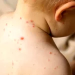 هشدار مینو محرز درباره آمار فاجعه‌بار سرخک در ایران
