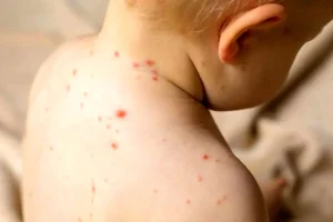 Read more about the article بازگشت سرخک در ایران؛ هشدار مینو محرز و نقشه راه توقف اپیدمی